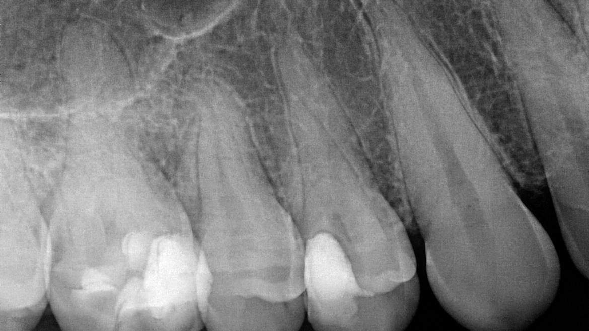 Интраорална сегментна рентгенография по Dick