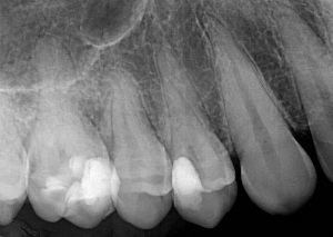 Интраорална сегментна рентгенография по Dick