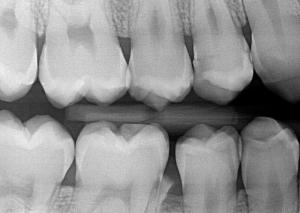 Интраорална кариес диагностика(Bitewing)