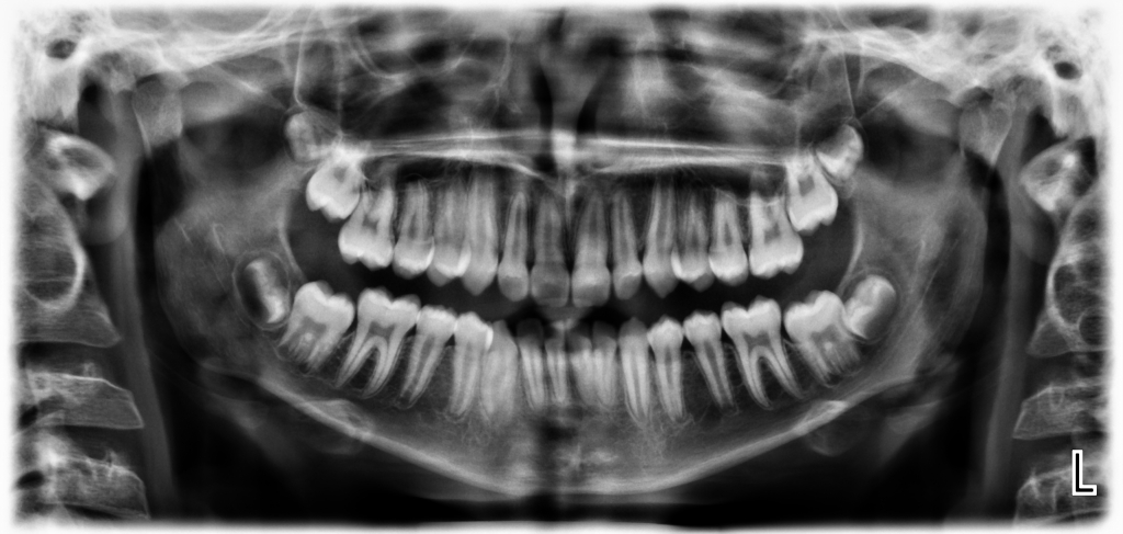 Панорамна рентгенография