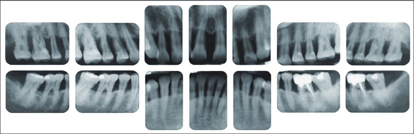 Пародонтален статус