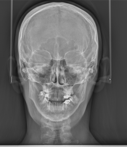 Телерентгенография -лицева проекция фас