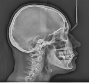 Телерентгенография - профилна проекция 2